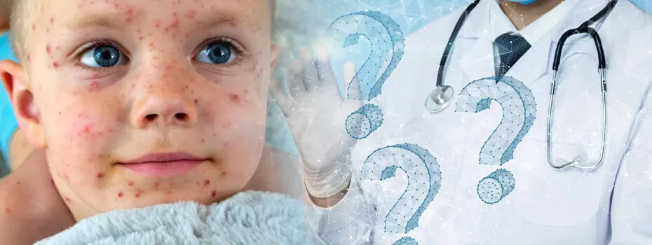 শিশুদের হাম সম্পর্কে প্রশ্নোত্তর