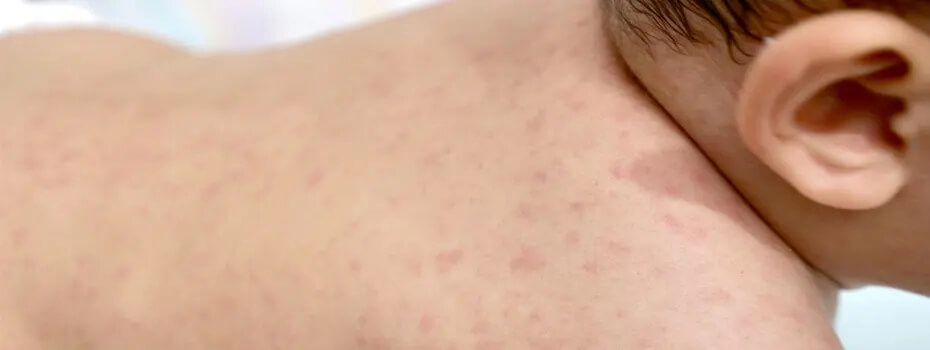 শিশুদের হাম (Measles): লক্ষণ, কারণ, চিকিৎসা ও করণীয়