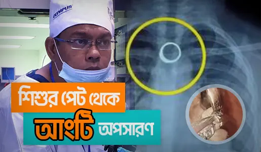 Ring Removal from Esophagus